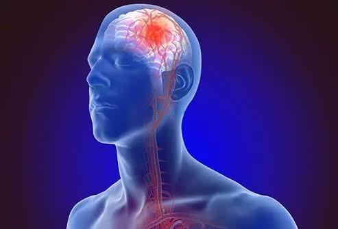 World Brain Day: One Nigerian Suffers Stroke Every Minute, Neurologists Warn
