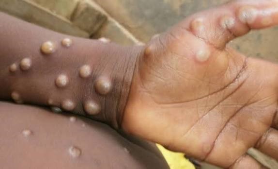 Benue Investigates Suspected Mpox Case in Konshisha, Health Commissioner Urges Calm Amid Surveillance Response