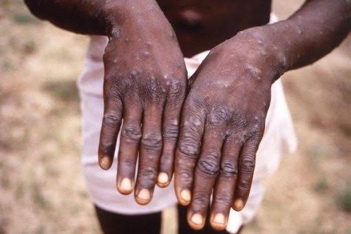 Benue Dismisses Suspected Mpox in Kornya
