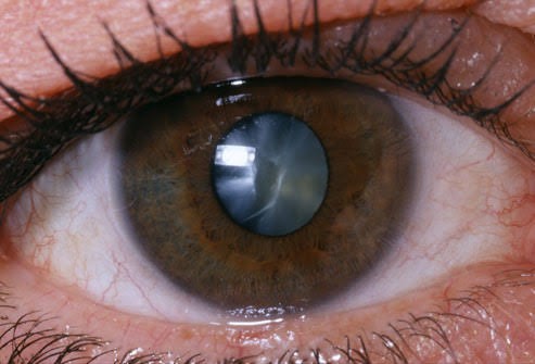 FG Targets 25,000 Nigerians for Free Cataract Surgery Under Renewed Hope Health Connect