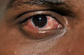 ‘Apollo’ Eye Infection Spreads in Bauchi, Assembly Speaker Affected