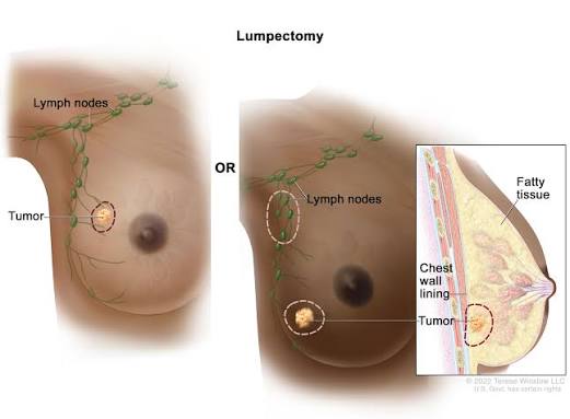 Nigerian Scientist Leads AI Research Team On Safer Breast Cancer Treatment