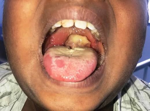 20–30% of Katsina Diphtheria Patients May Die, State’s NMA Chair Warns