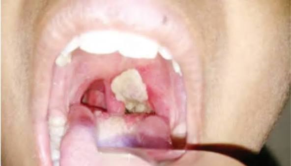 Diphtheria Outbreak in Zamfara: 39 Children Dead, 261 Suspected Cases as Vaccine Gaps Fuel Silent Return