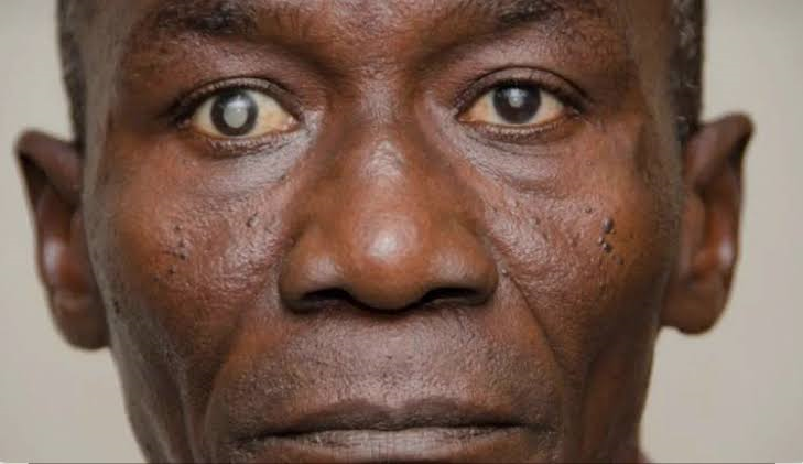 84% of 24 Million Sight Loss Cases in Nigeria Preventable, OSN Raises Alarm as Digital Eye Care Offers New Hope