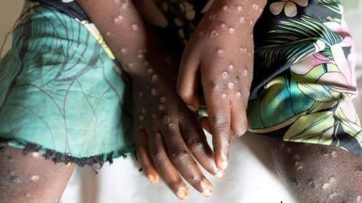 WHO Warns of Hidden Mpox Spread in Africa